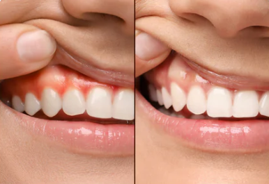Strong Tooth Restore Jaw Before and After